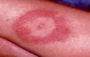 erythema_migrans.jpg 